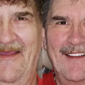 𝐁𝐢𝐤𝐞𝐧𝐝𝐚® –🦷Advanced Customized Full Denture Set🦷🇺🇸 (⏰Limited time discount last 30 minutes⏰)