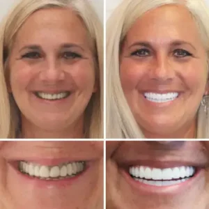 𝐁𝐢𝐤𝐞𝐧𝐝𝐚® –🦷Advanced Customized Full Denture Set🦷🇺🇸 (⏰Limited time discount last 30 minutes⏰)