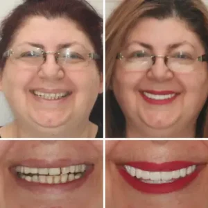 𝐁𝐢𝐤𝐞𝐧𝐝𝐚® –🦷Advanced Customized Full Denture Set🦷🇺🇸 (⏰Limited time discount last 30 minutes⏰)