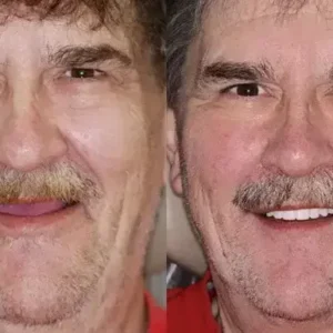 SMILE HZA™ Premium Denture