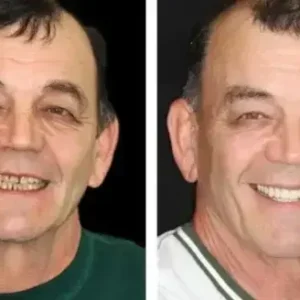 SMILE HZA™ Premium Denture